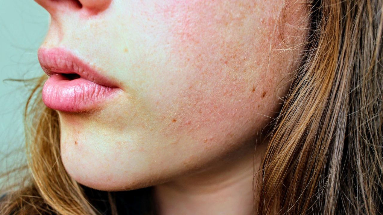 Does Whey Protein Cause Acne?